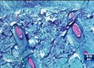 First Case of New Form of MPOX Reported in US Traveler – WSVN 7News | Miami News, Weather, Sports | Fort Lauderdale news-17112024-021356