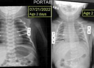 Mother in South Florida Claims Infant Twins Have Genetic Condition, Denies Abuse – WSVN 7News | Miami Fort Lauderdale mother-in-south-florida-claims-nfant-twins-have-genetic-condition-denies-abuse-wsvn-7news-miami-fort-lauderdale