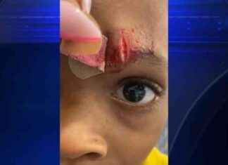 Mother Seeks Answers After Son Returns Home with Cut from Teacher – WSVN 7News Miami mother-seeks-answers-after-son-returns-home-with-cut-from-teacher-wsvn-7news-miami