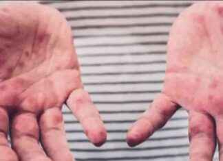 Measles Outbreak: 3 Cases in NJ, Child Dies in Texas measles-outbreak-3-cases-in-nj-child-dies-in-texas